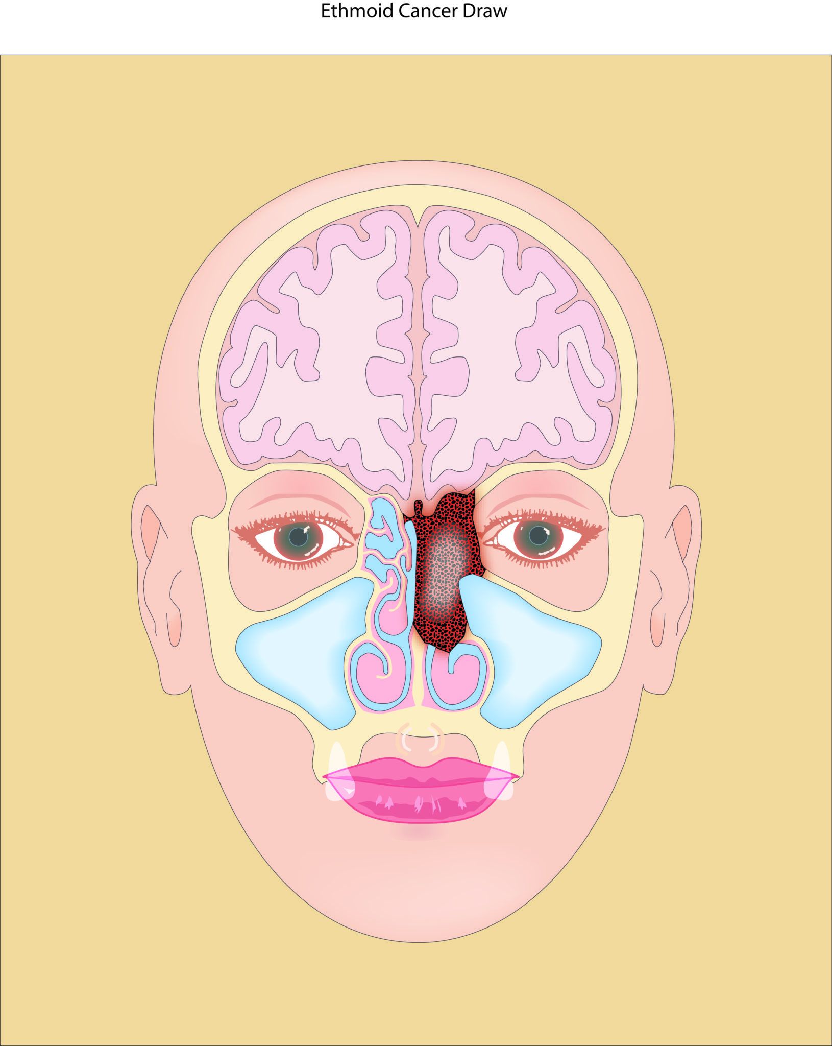 sinus cancer
